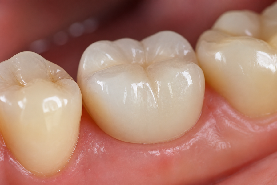 Zirconium crowns